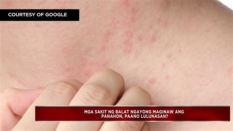 gamot sa sakit sa balat ng baboy|Iba’t ibang uri ng sakit sa balat .